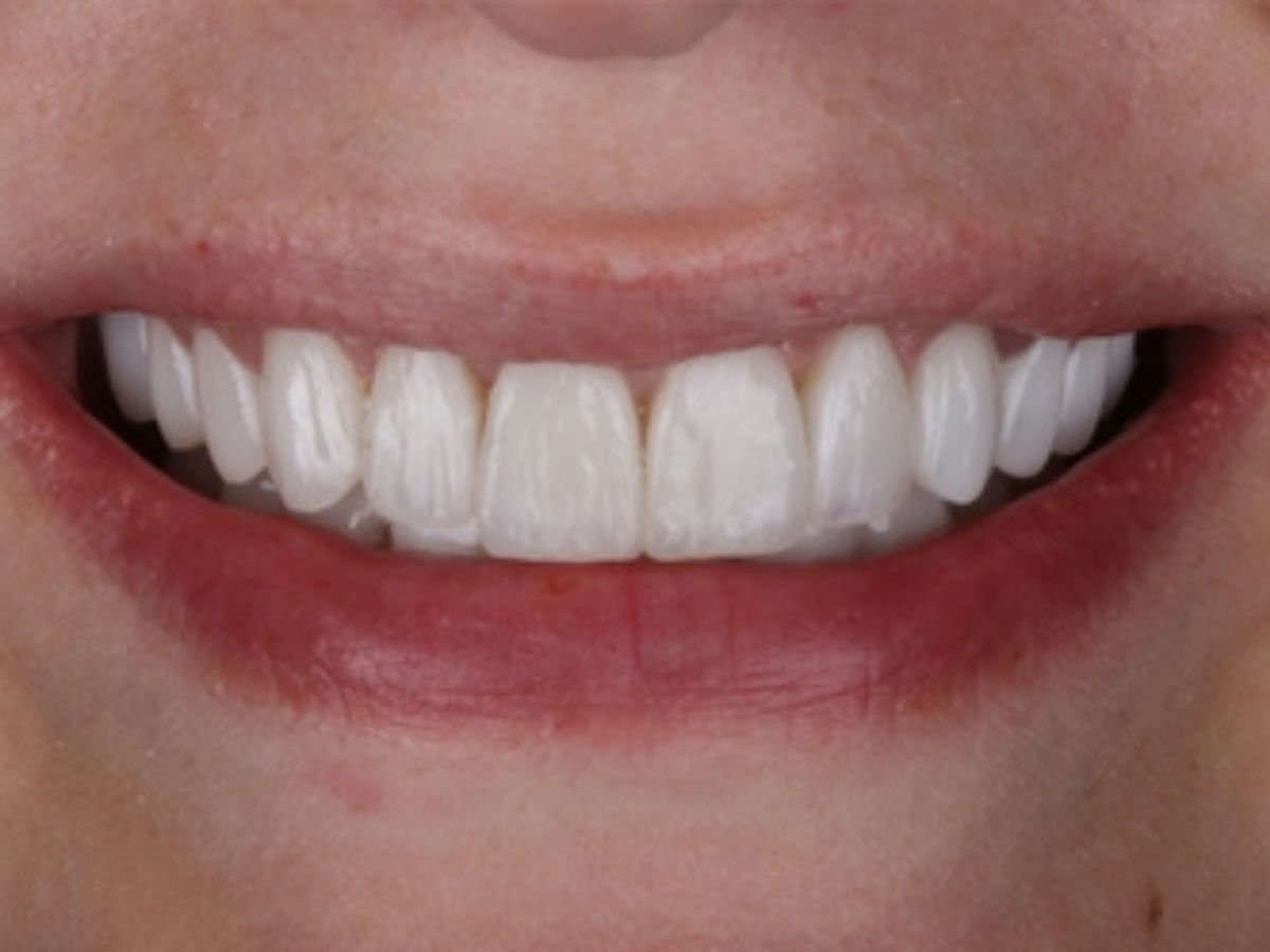 After veneers
