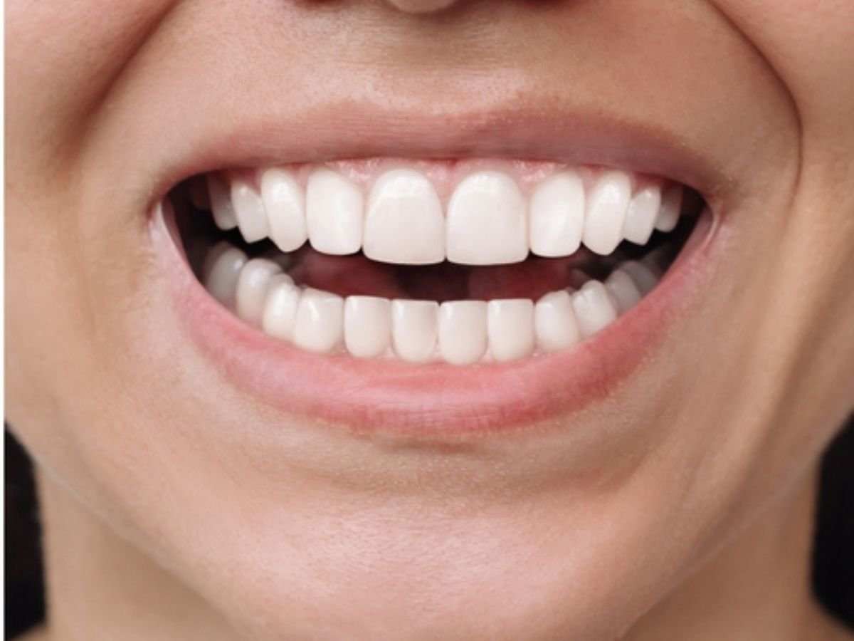 After braces