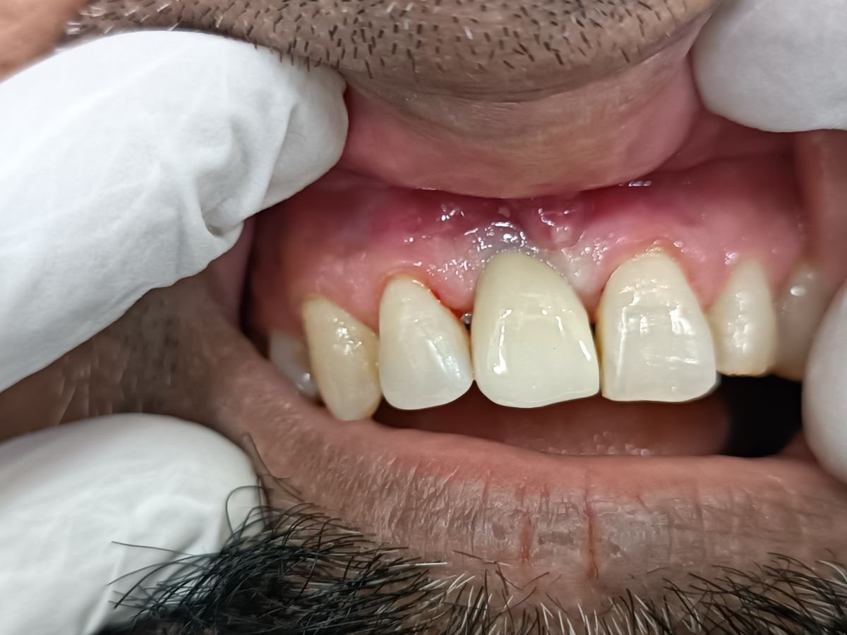 After implants