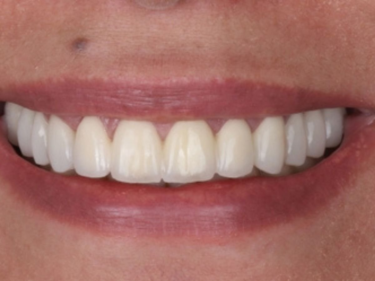 After smile makeover and bite correction