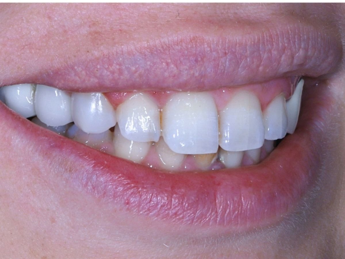 After composite bonding
