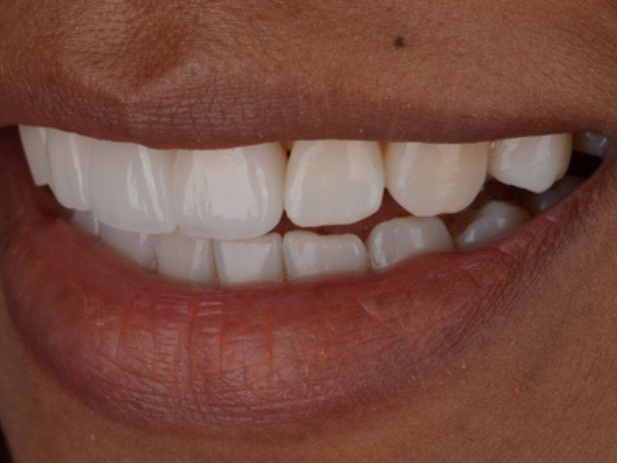 After gap closure