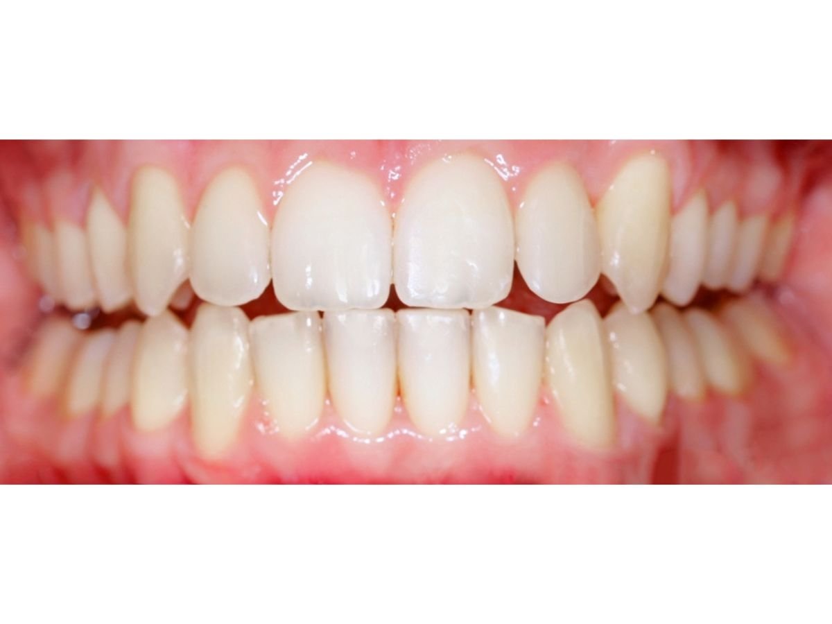 After Invisalign