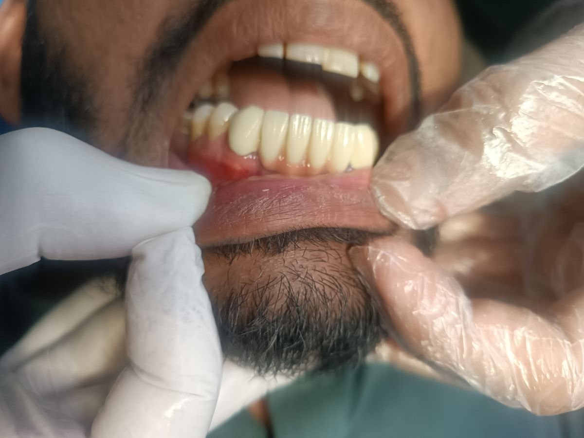 After dental crowns