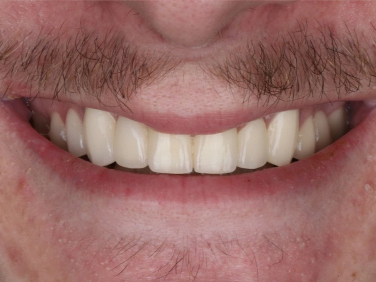 After dental bridges