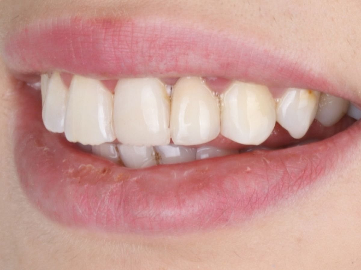 After dental fillings