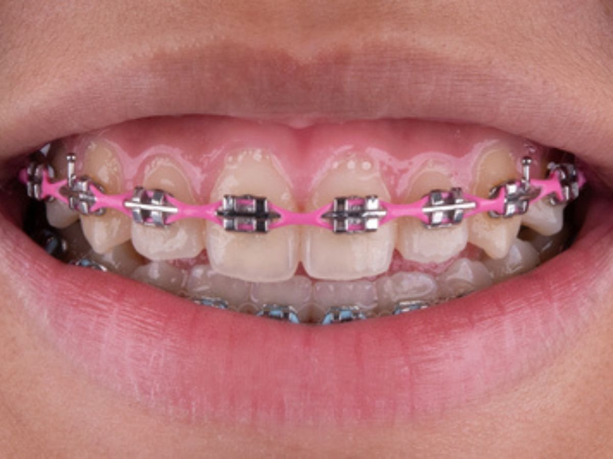 After metal braces