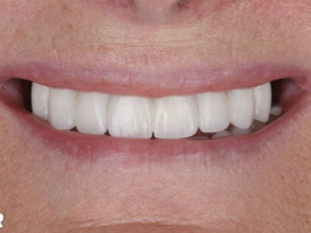 After full mouth rehabilitation