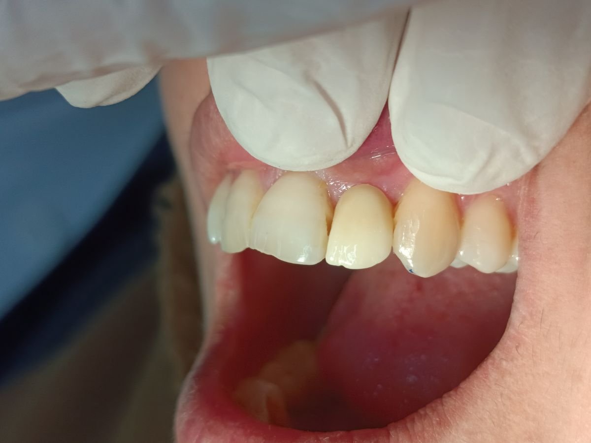 After zirconia crown