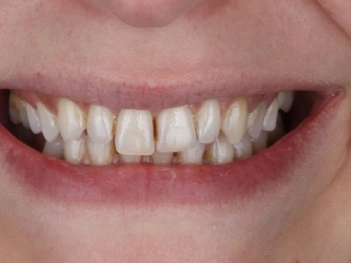 Before veneers
