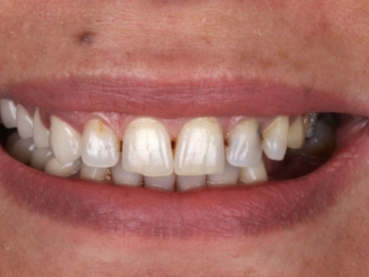 Before smile makeover and bite correction