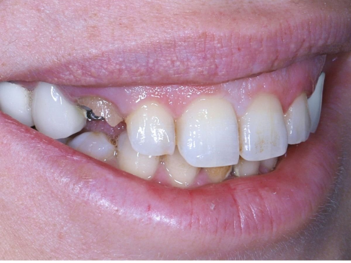 Before composite bonding