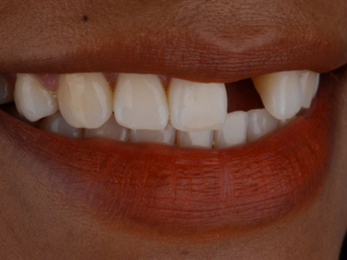 Before gap closure