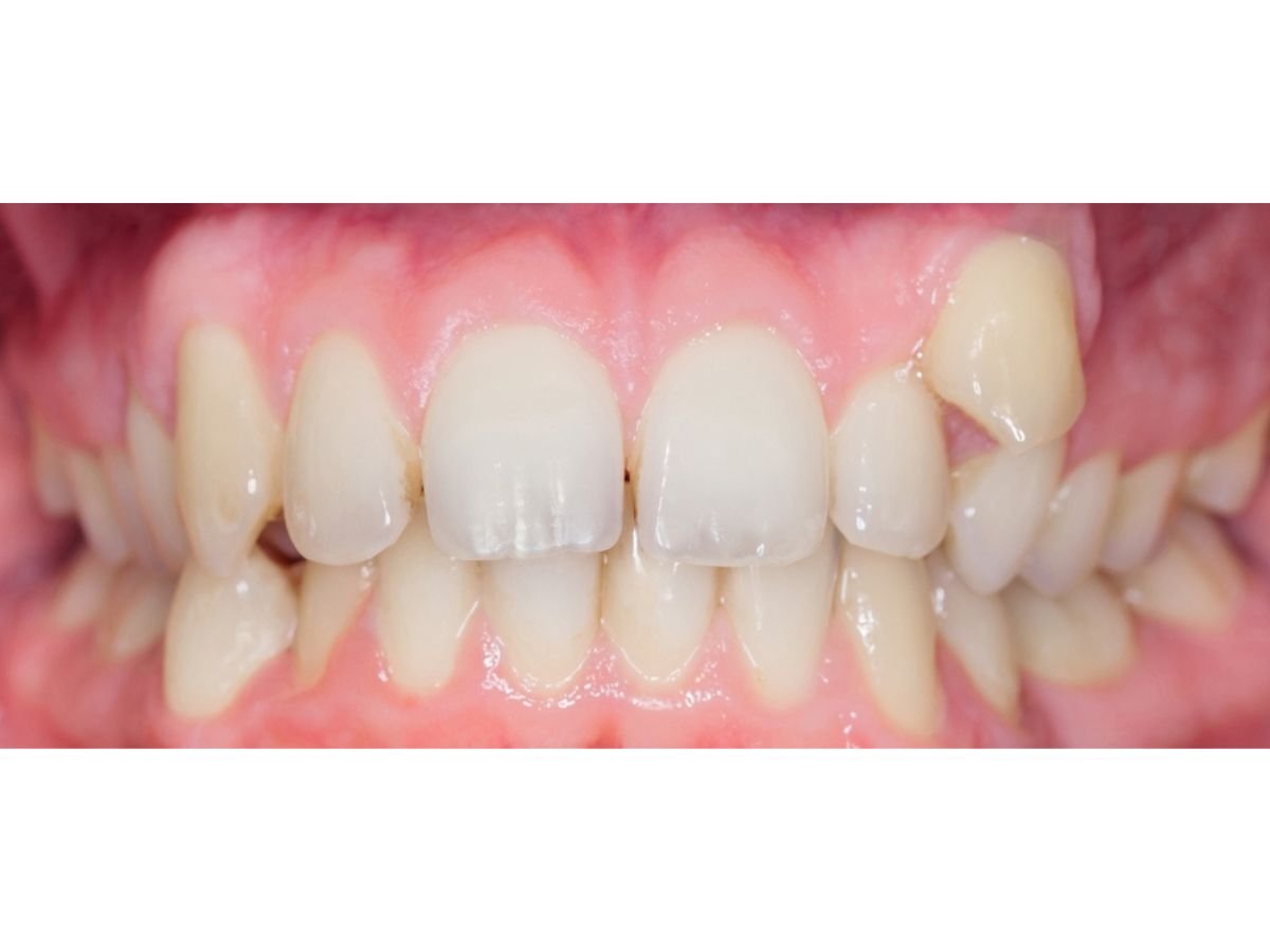 Before Invisalign