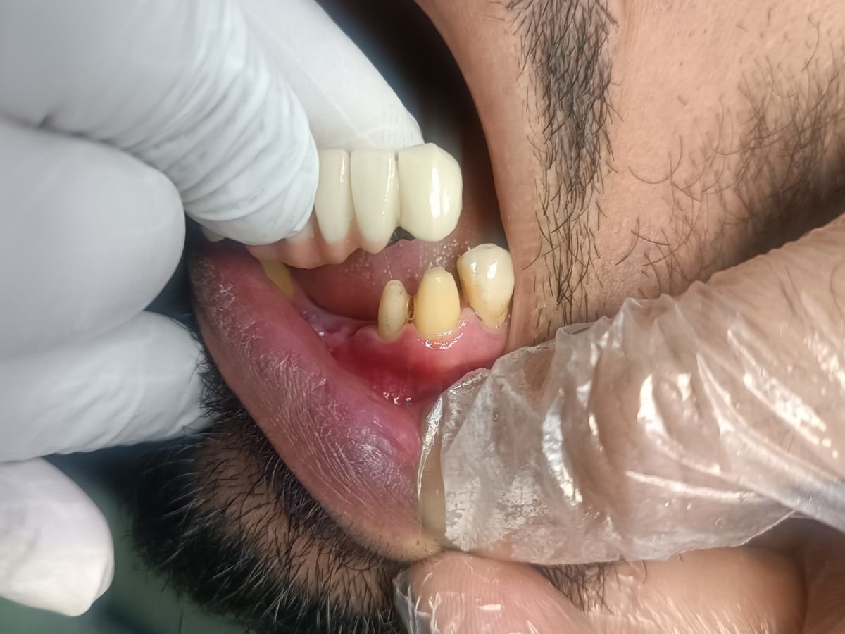 Before dental crowns