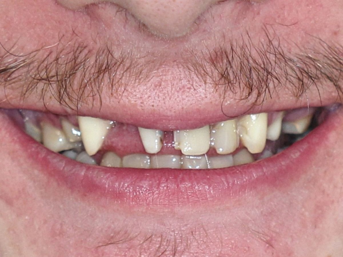 Before dental bridges