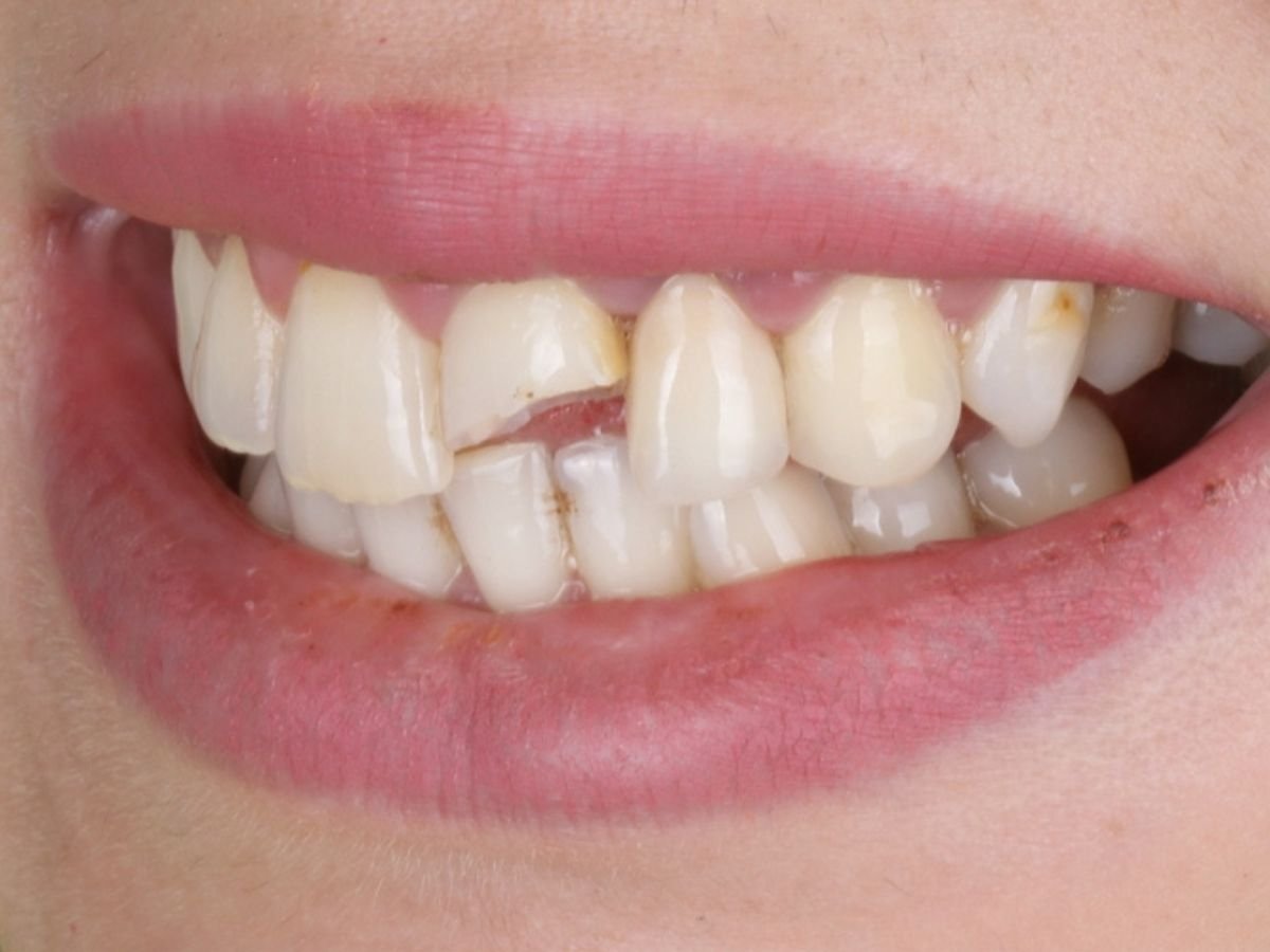Before dental fillings