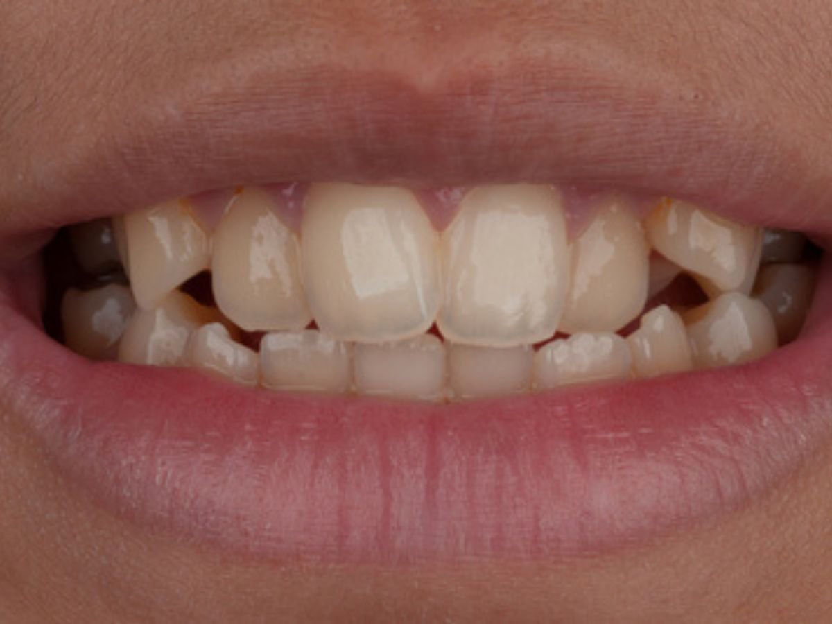 Before metal braces