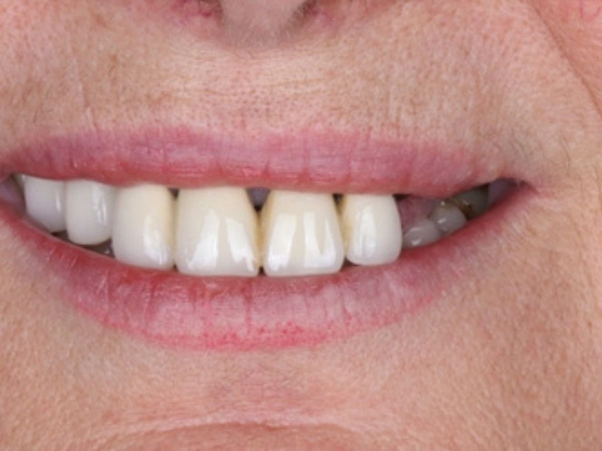 Before full mouth rehabilitation