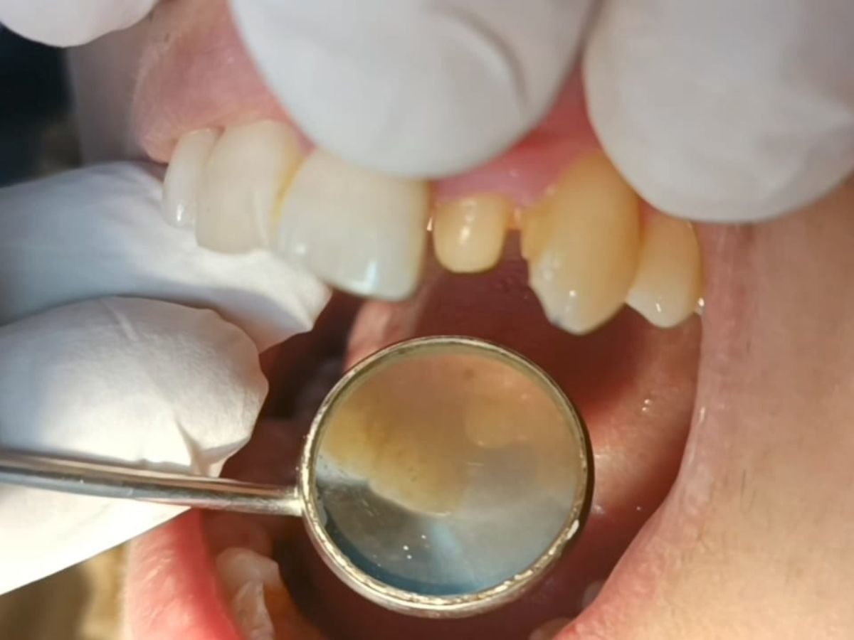 Before zirconia crown