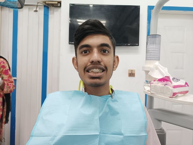 Braces orthodontic treatment