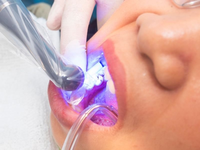 Composite bonding