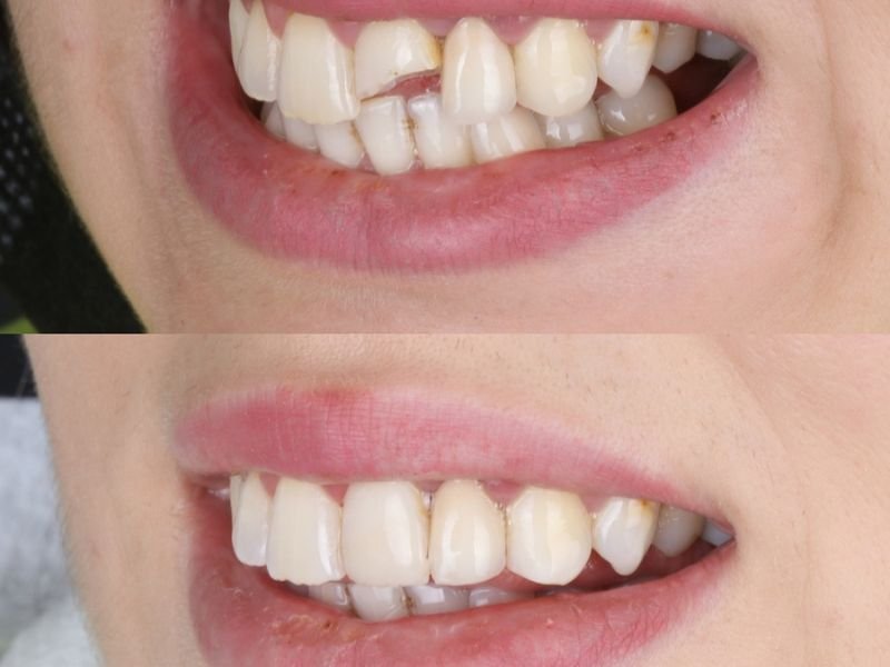Cracked tooth treatment