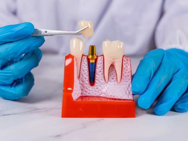 Dental implants