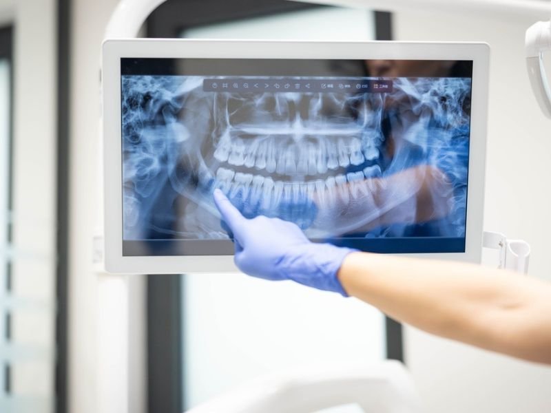 Dental X-Ray