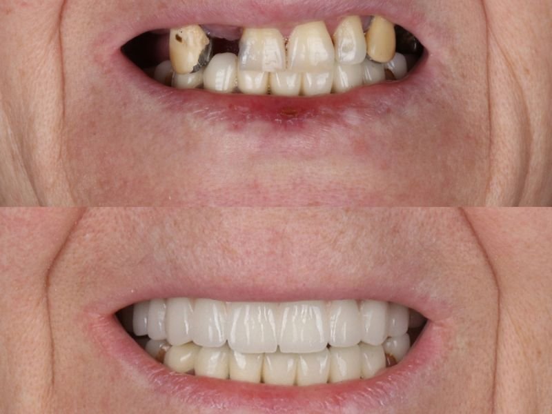 Full mouth rehabilitation