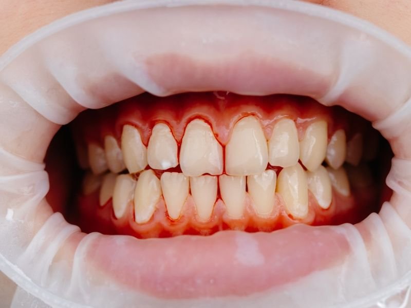 Gum disease treatment