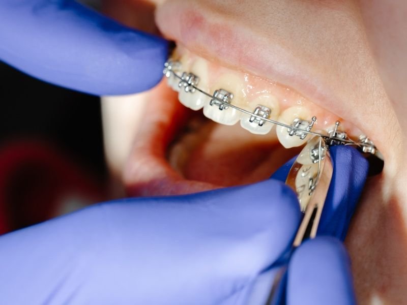 Metal braces