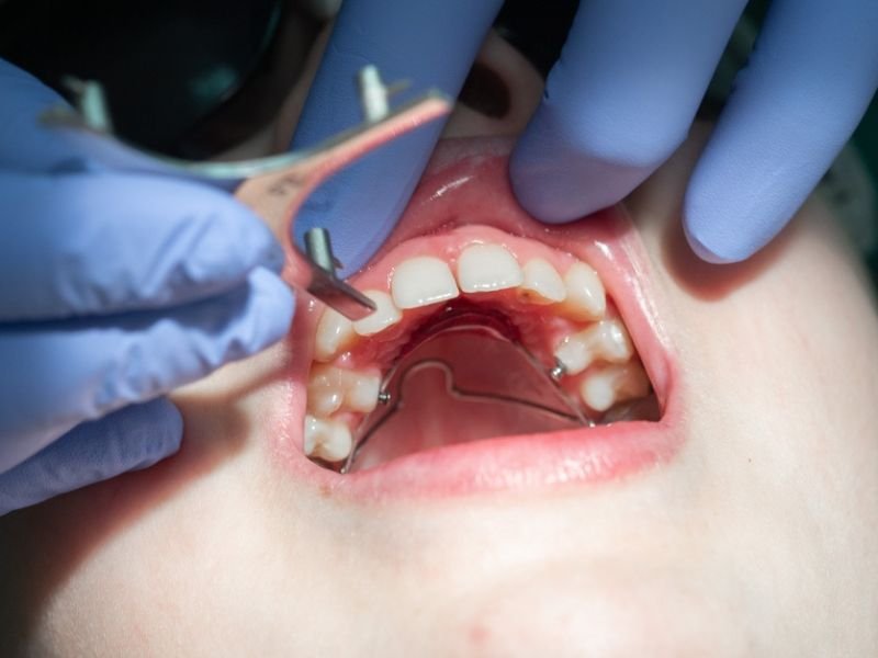 Pediatric dentistry