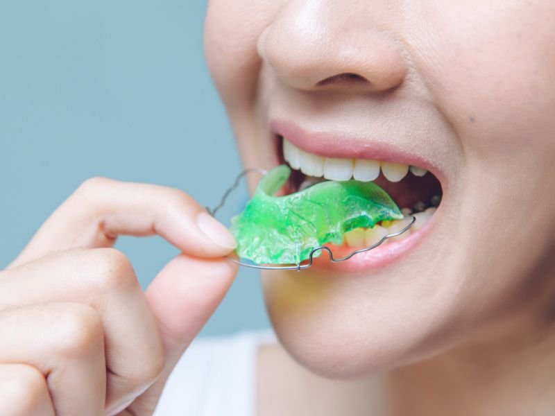 Dental retainers