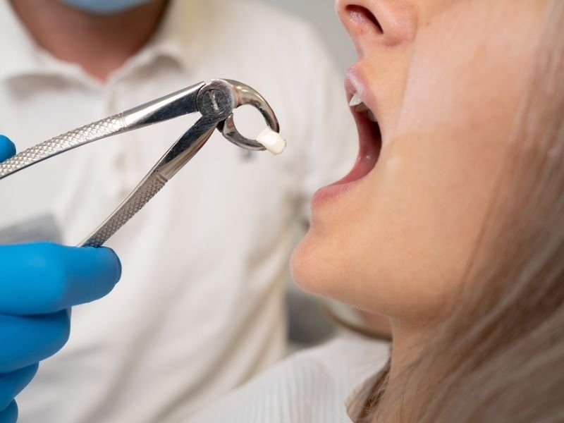 Surgical extraction
