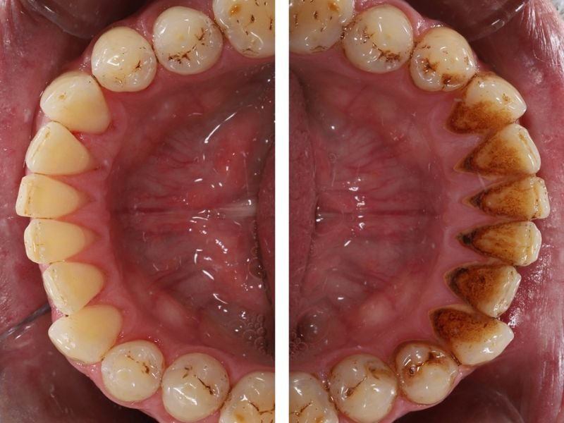Teeth scaling treatment