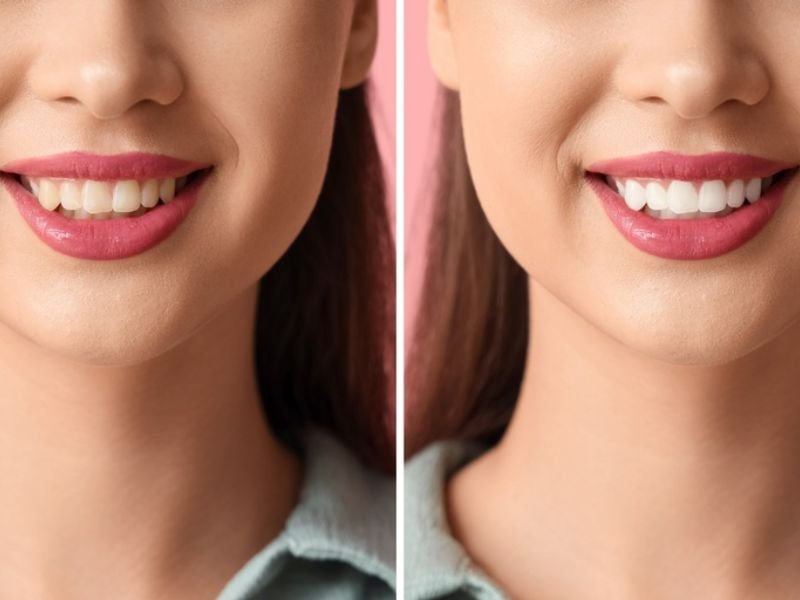 Teeth whitening treatment