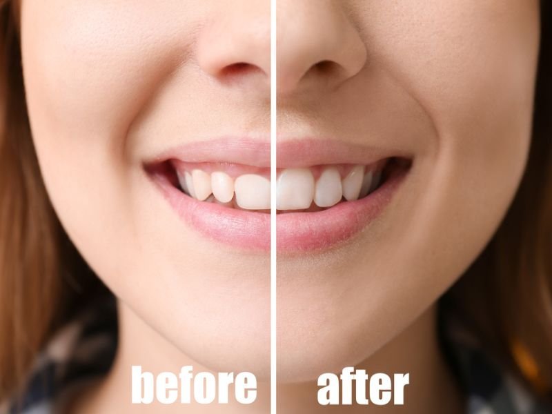 Tooth contouring and reshaping