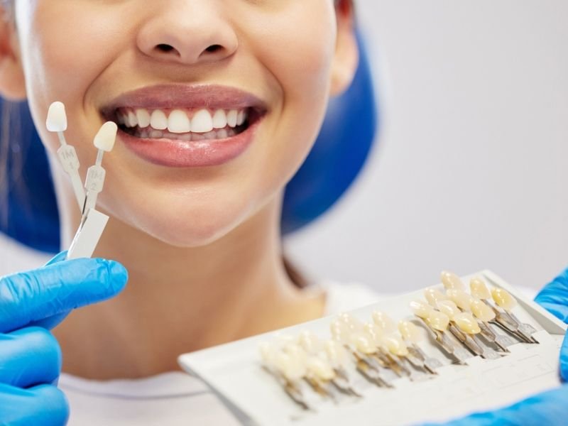 Dental veneers